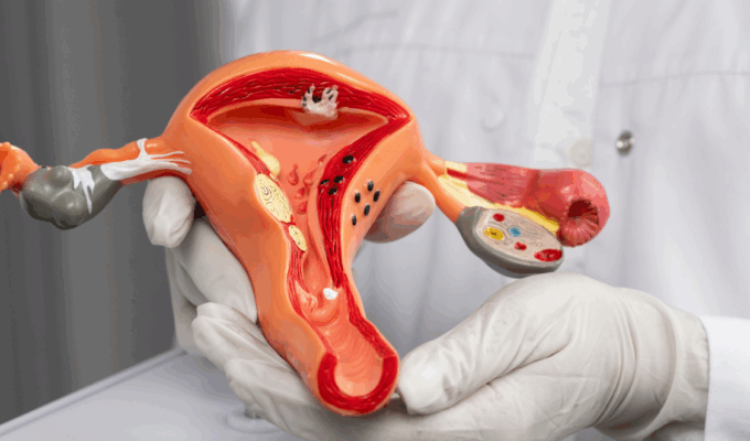 Doctor holding a uterus model to explain PCOS in African women.