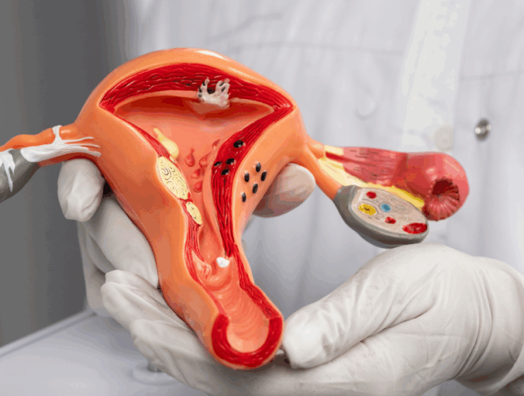 Doctor holding a uterus model to explain PCOS in African women.